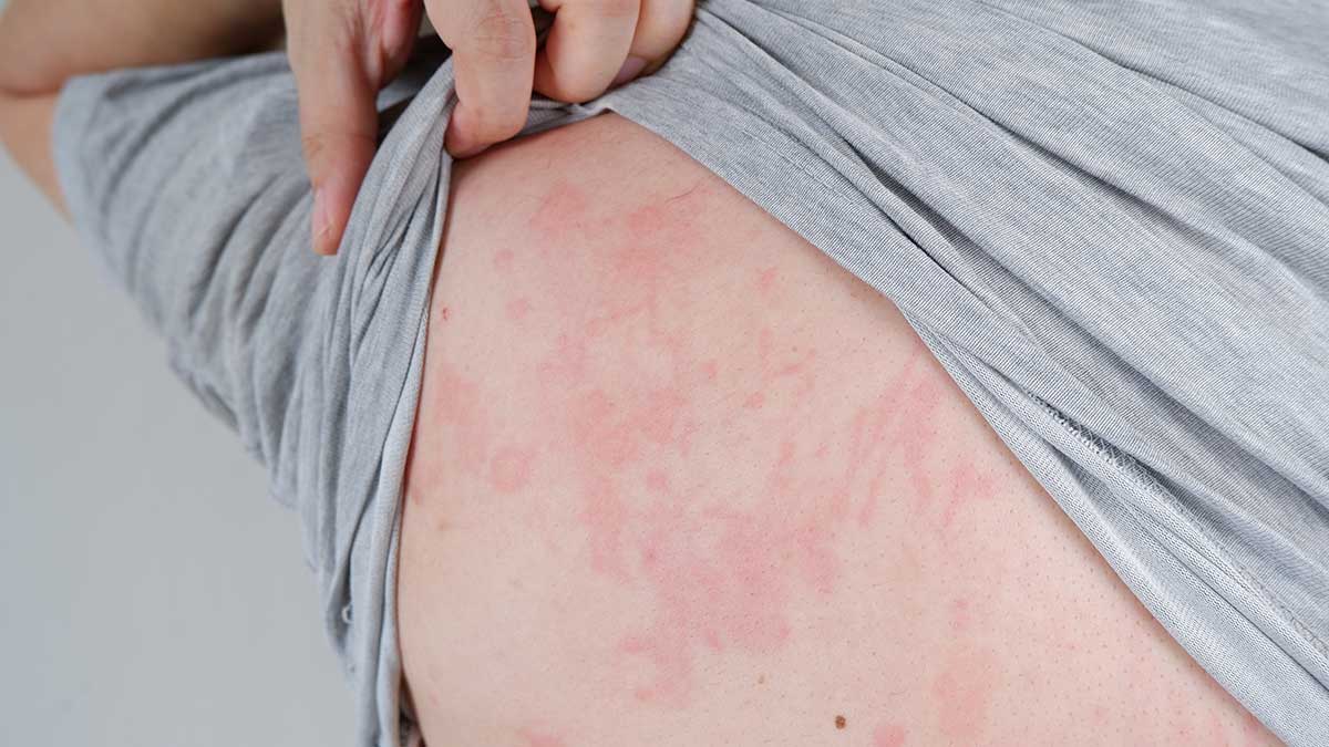 Food allergens and hives and rashes